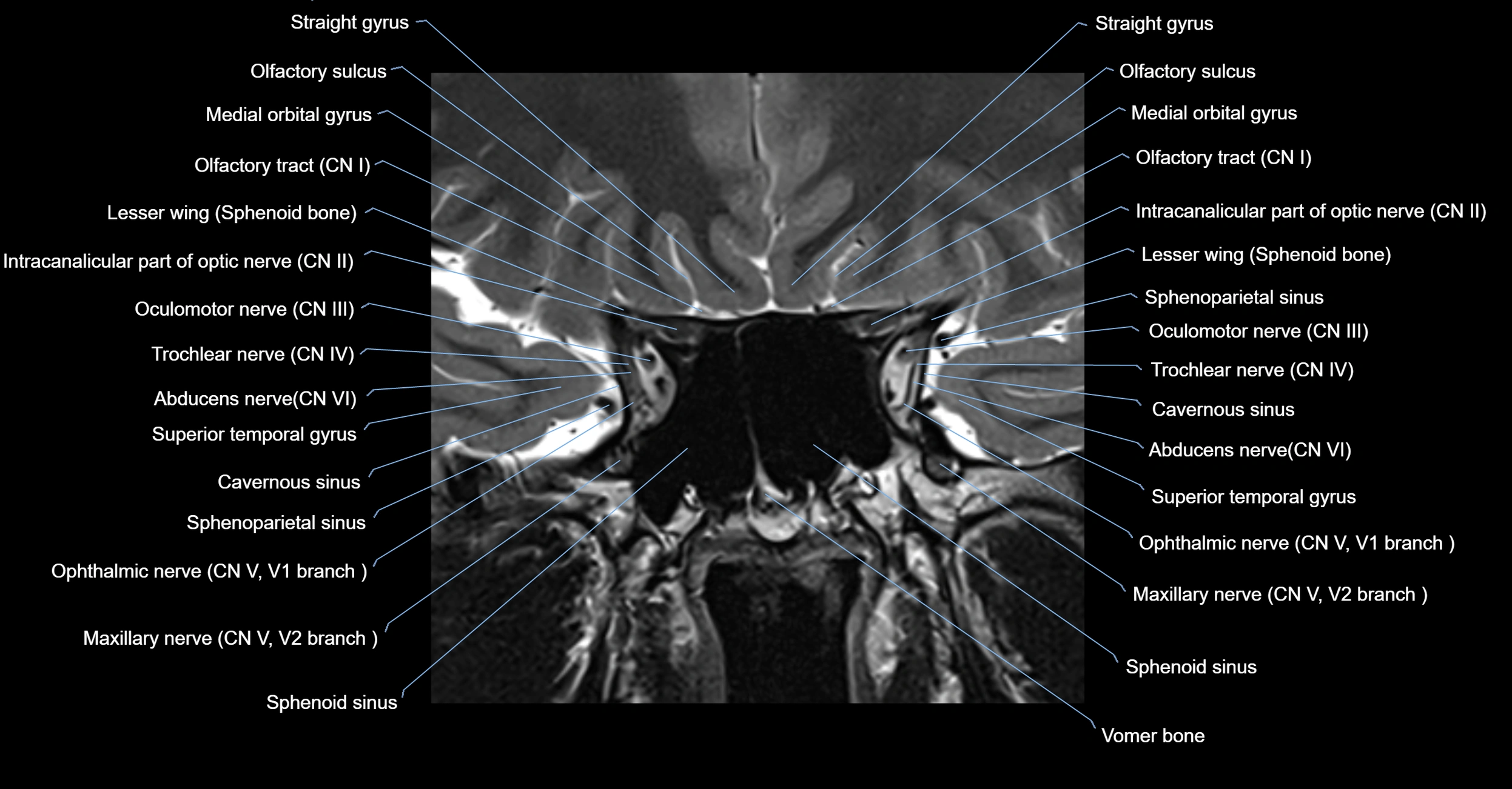 MRI cavernous sinus coronal cross sectional 3T anatomy image-img-00001-00003.webp